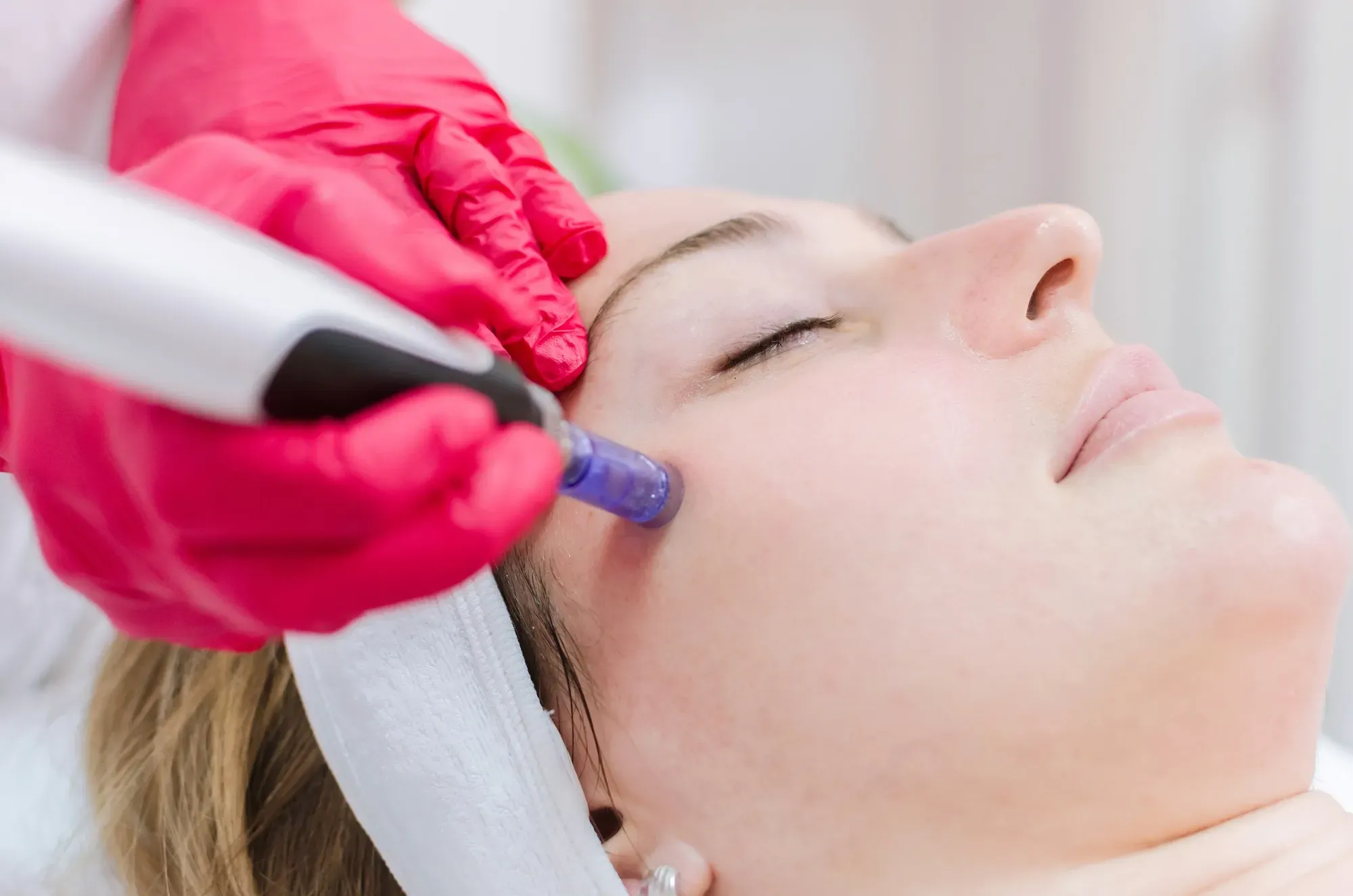 Microneedling of face